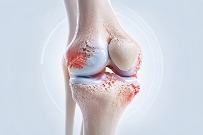 Arthrose